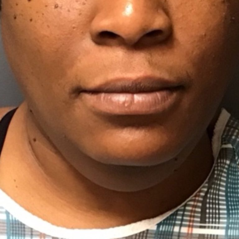 Chin liposuction before — 37-year-old woman, front view
