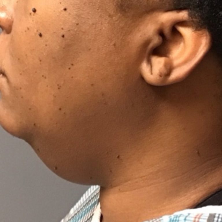 Chin liposuction before — 37-year-old woman, left side view