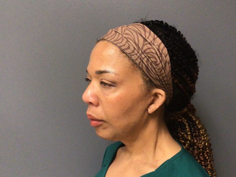 Facelift case 02, angled view three months after surgery
