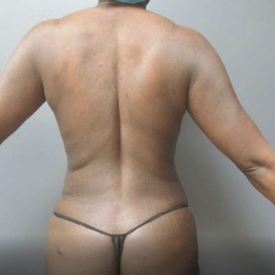 Body contouring, after