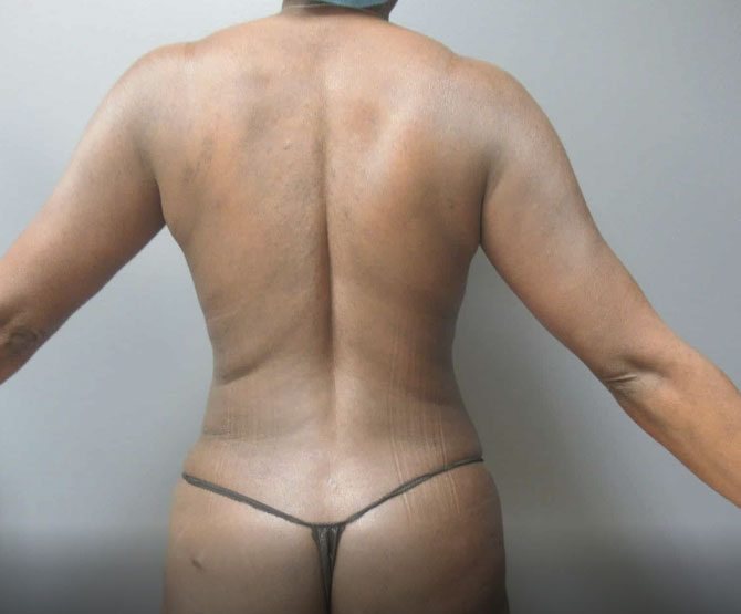 Body contouring, after
