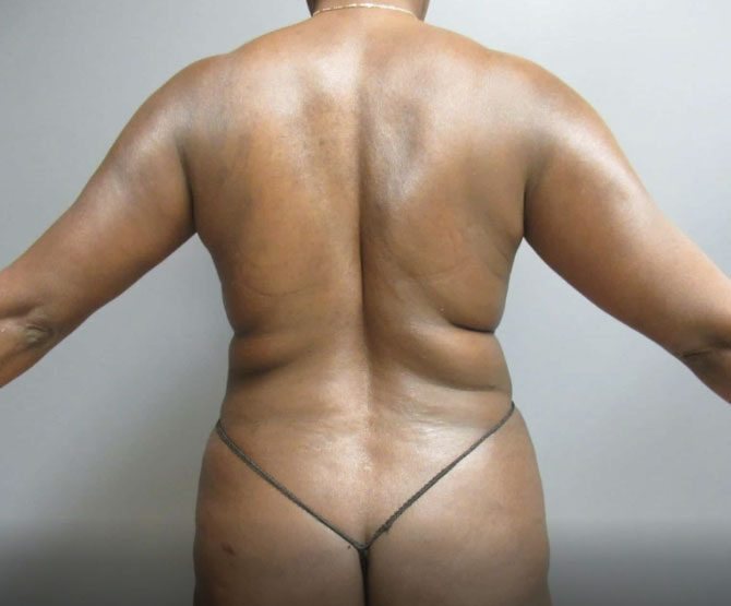 Body contouring, before