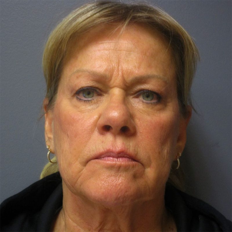Facial procedure, before