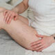 Close up a woman's thigh with spider vein - Michelle Hadraway M.D.