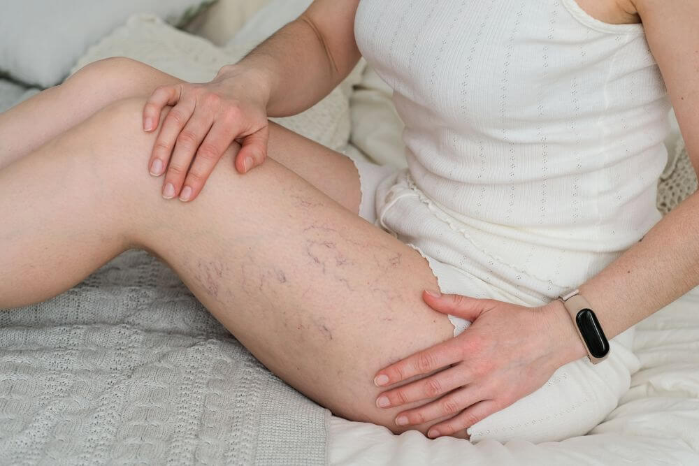 Close up a woman's thigh with spider vein - Michelle Hadraway M.D.