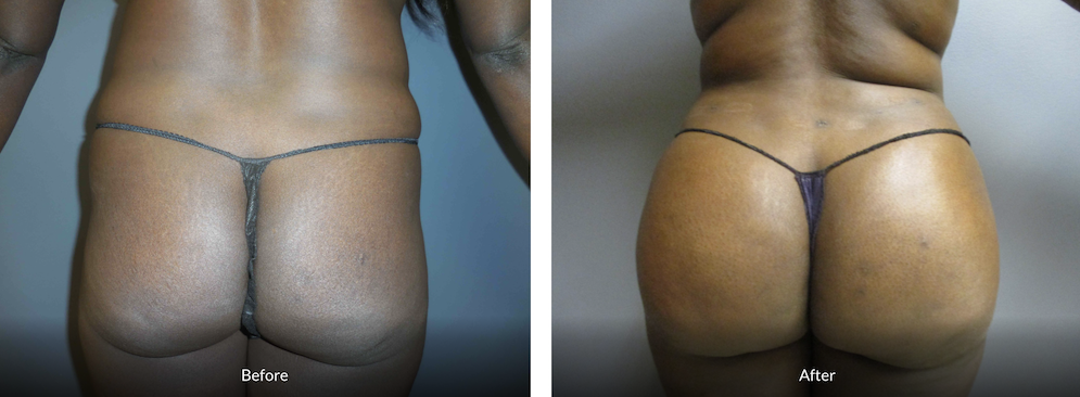 36 year old female 4 months after BBL (fat transfer to the buttocks